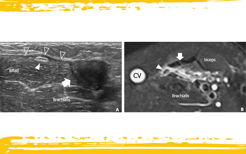 4. Nervio cutáneo lateral antebrazo.png